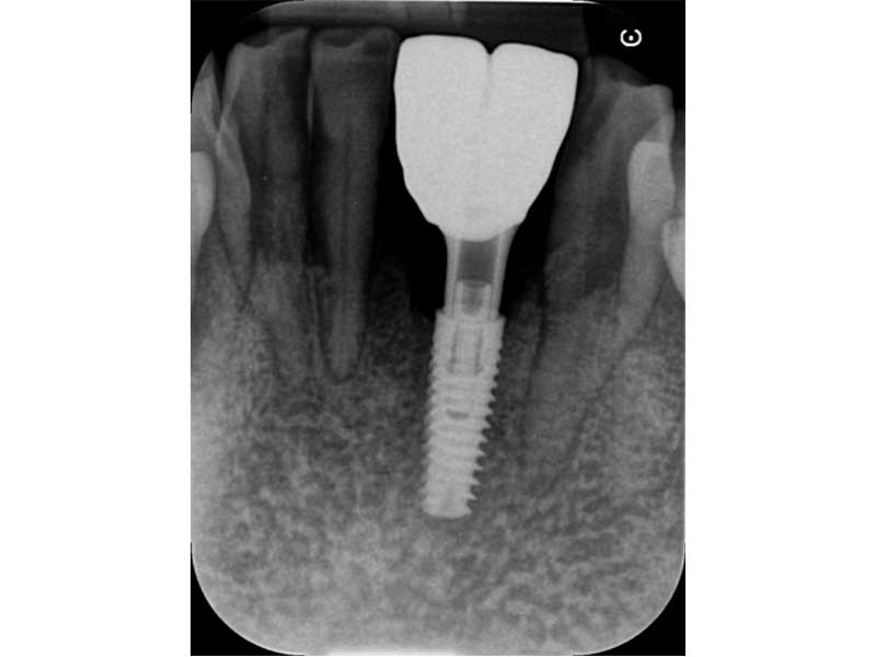 32-31 MIS C1 Inserted