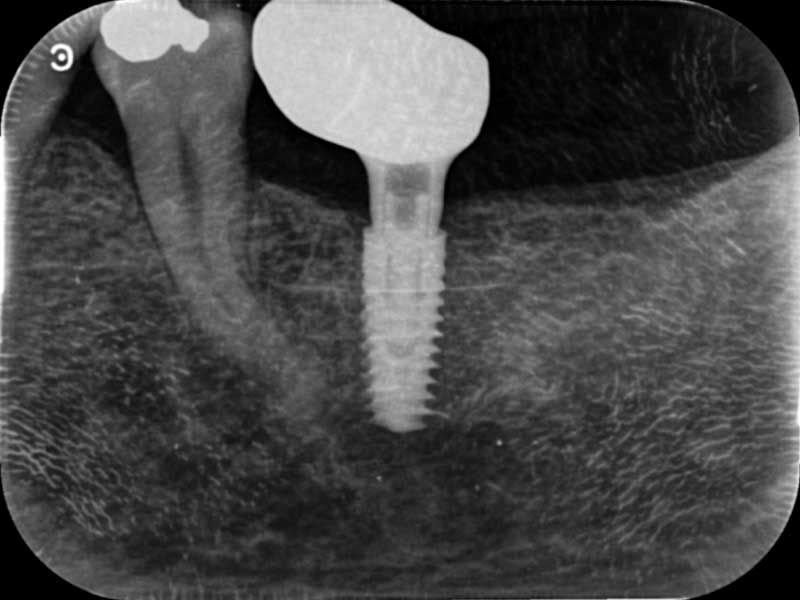 36 MIS C1 inserted