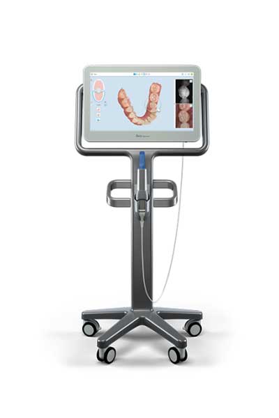Itero Scanner